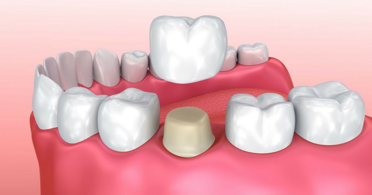 dental_crown_indications_sm.jpg dental_crown_indications_sm.jpg